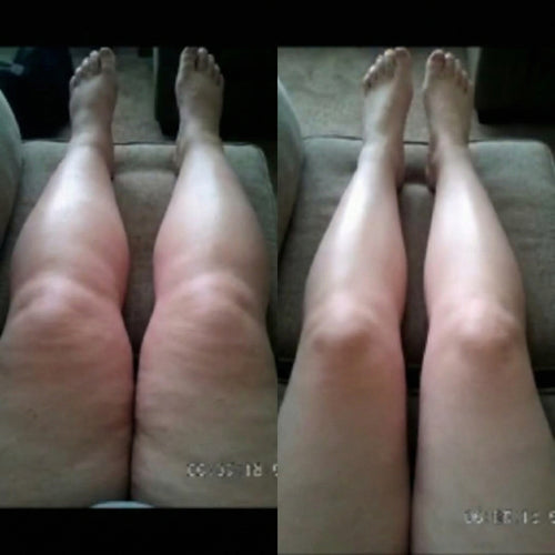 LINFATIC | Gotero para el Drenaje Linfático