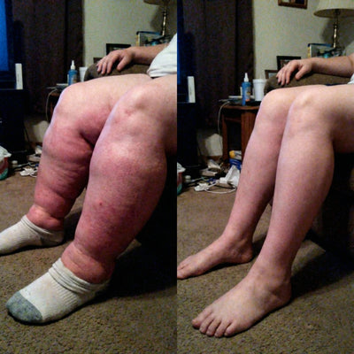 LINFATIC | Gotero Natural de Drenaje Linfático