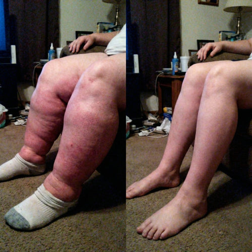 LINFATIC | Gotero Natural de Drenaje Linfático